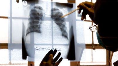 туберкулез