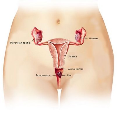 влагалищного рака