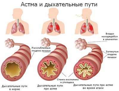 Биопрепараты от астмы: атаковать источник болезни, а не симптомы