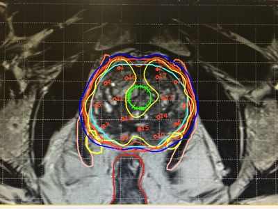 Брахитерапия доказала свою эффективность при лечении рака кожи