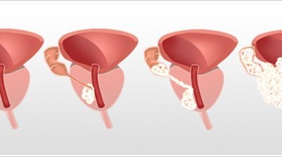 рака простаты