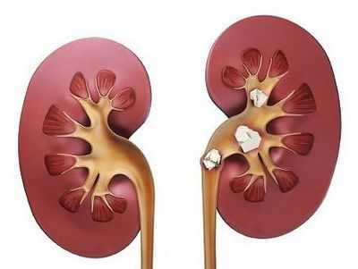 Выявлена ​​генетическая связь с камнями в почках