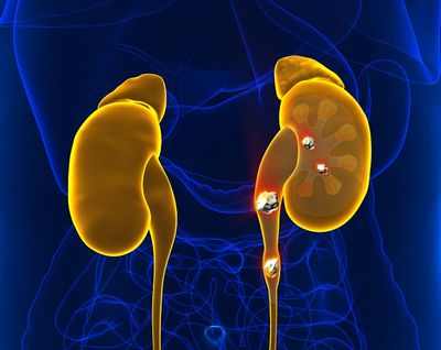 Устранение больших камней в почках с помощью тамсулозина