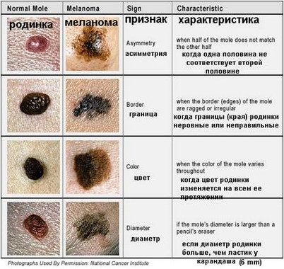 меланомы
