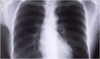 туберкулез