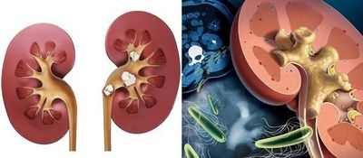 Открытие функции генов может помочь предотвратить камни в почках